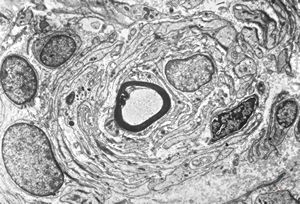 F,12y. | hypertrophic (onion bulb) neuropathy - n.suralis